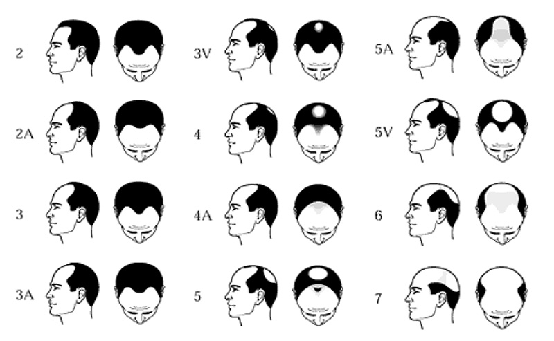 men&#039;s hair restoration,men&#039;s hair loss,Cesare Ragazzi